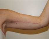 Feel Beautiful - Arm reduction San Diego Case 2 - After Photo
